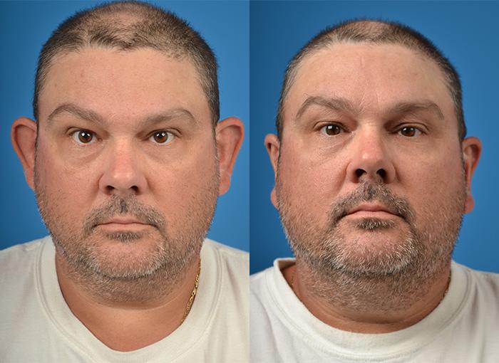 Otoplasty Photos Melbourne, FL Patient 26818